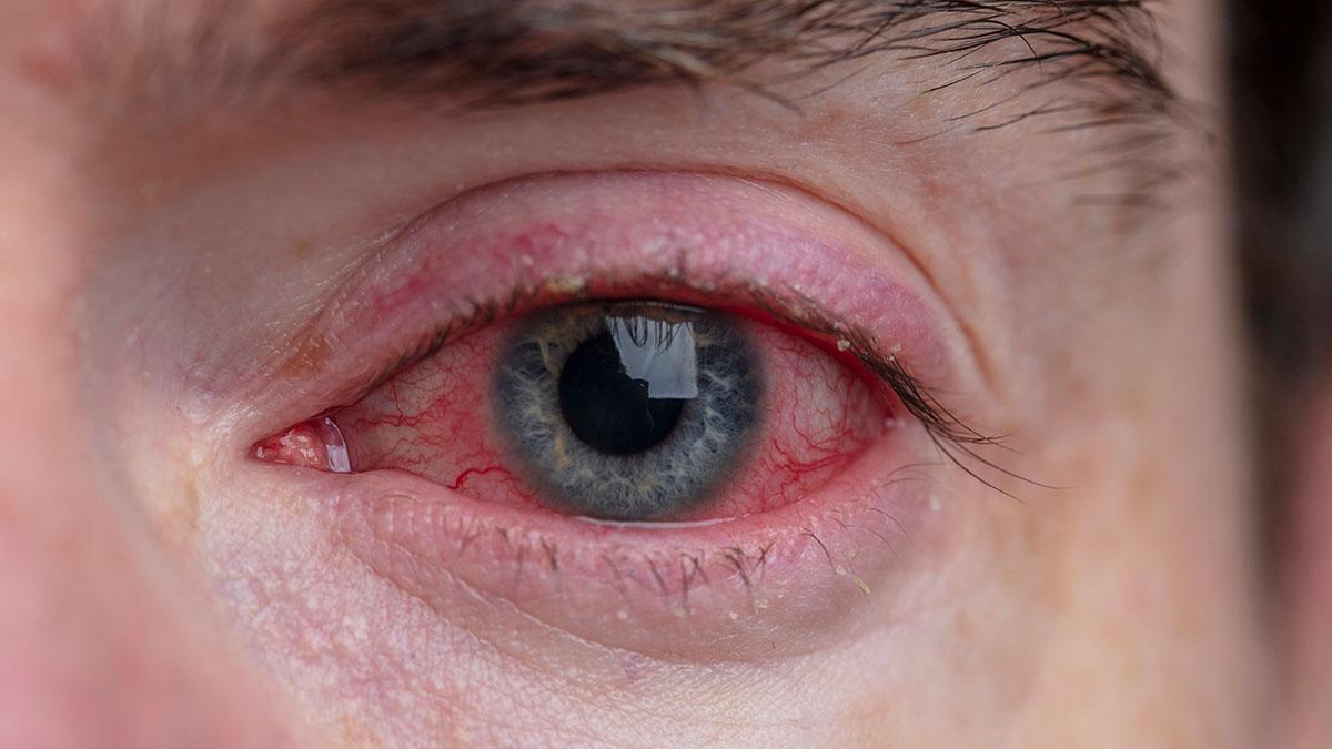 kırmızı göz hastalığı