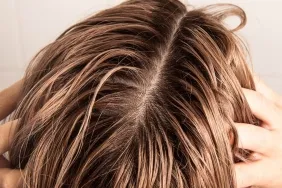 Yağlı Saçlarda Kuru Saç Derisinin En Yaygın Nedenleri ve Tedavi