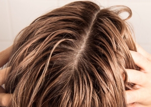 Yağlı Saçlarda Kuru Saç Derisinin En Yaygın Nedenleri ve Tedavi