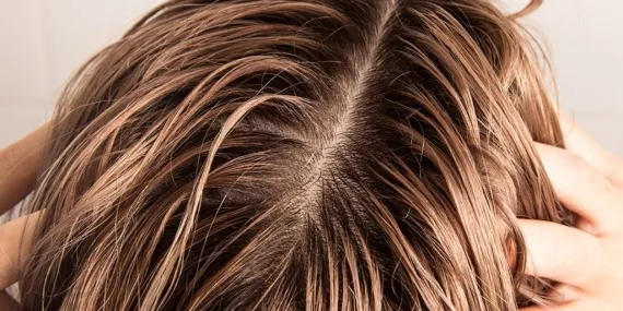 Yağlı Saçlarda Kuru Saç Derisinin En Yaygın Nedenleri ve Tedavi Yöntemleri