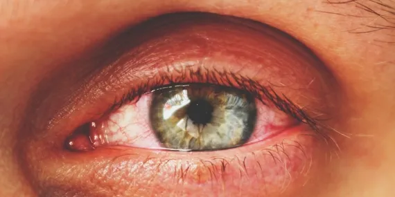 Kırmızı Göz Hastalığı Nedir, Belirtileri Nelerdir?
