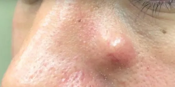 Ağrılı akneleri sıkanlar bin pişman! Çok basit bir yöntemle kurtulabilirsiniz…