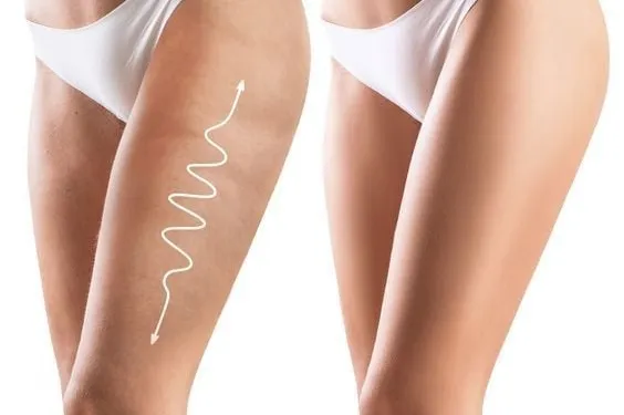 Birkaç basit hareket ile selülitlere veda edin!