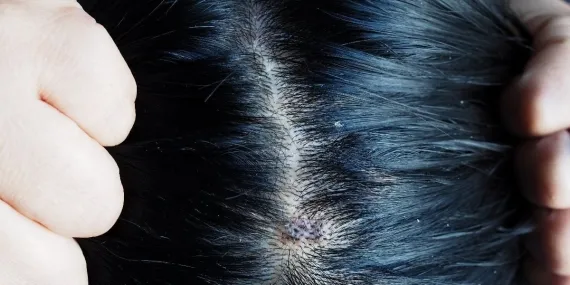 Saç derinizde kaşıntı sorunu varsa çözümü çok basit!