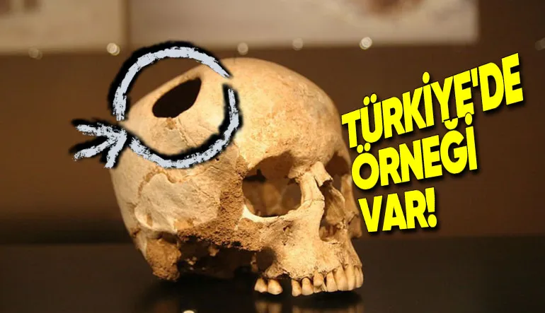 Eski Dönemlerde Neden İnsanların Kafasına Koca Koca Delikler Açılıyordu? (Günümüzde de Yapılabiliyor!)