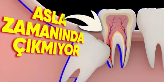 Yirmilik Dişlerin Genelde Yirmili Yaşlardan Sonra Çıkmasının Biraz Sinirinizi Bozacak Sebepleri
