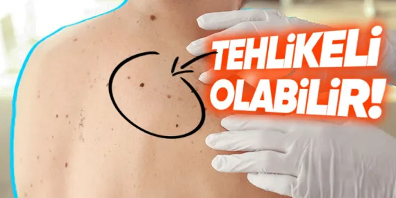 Herkesin Vücudunda Çeşit Çeşit Olan Benler Neden ve Nasıl Oluşuyor?