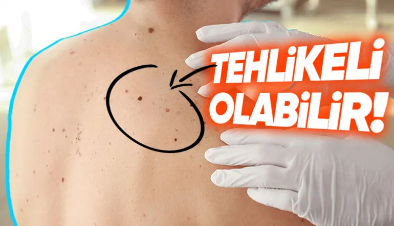 Herkesin Vücudunda Çeşit Çeşit Olan Benler Neden ve Nasıl Oluşuyor?